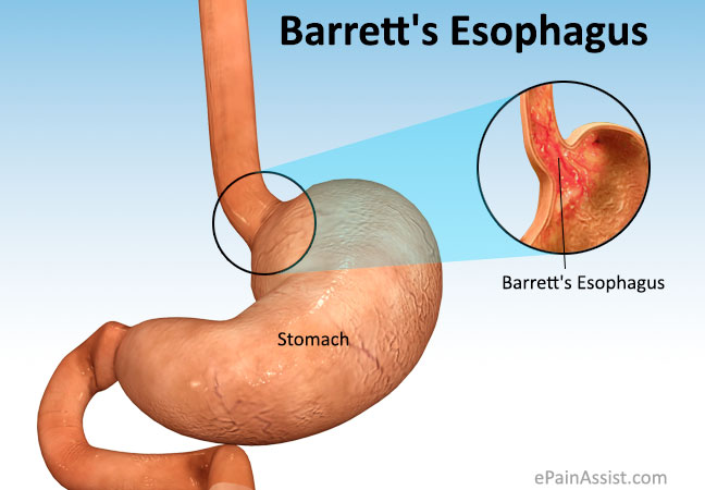 Barretts-Esophagus